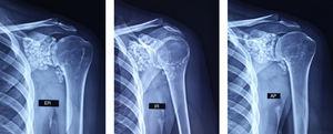 Radiographs of the shoulder in true anteroposterior (AP), external rotation (ER) and internal rotation (IR) positions revealed the presence of multiple calcified bodies of the same size, distributed throughout the entire glenohumeral joint, as well as the subscapularis recess and the bicipital groove.