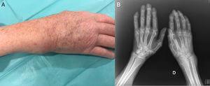 (A) Image of the patient's right wrist. Soft tissue mass located in the region of ulna that responded to pressure and was mobile. (B) Plain bilateral radiographs of the hands. Generalized osteopenia, reduction of the joint space in right wrist. Thickening of soft tissue most evident in the region of the ulnar styloid. Severe distortion of the architecture of the radiocarpal joint and ulnocarpal fossa.