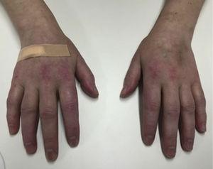 Photograph showing Gottron papules over the extensor surfaces of metacarpophalangeal joints of both hands.