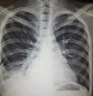 A 22-year-old man with a twin brother with systemic lupus erythematosus. Both showed evidence of Schnitzler syndrome (intermittent episodes of fever, urticaria, abdominal pain, angioedema, arthritis). He had a 2-month history of progressive dyspnea even on minimum exertion, polyarthritis, hypertension, mechanical edema and, on the preceding days, cough and increased dyspnea. Exploration revealed Chávez’ pulmonary complex and right basal condensation syndrome; radiograph showing evidence of pulmonary hypertension, 4 arches, right basal pneumonitis and homolateral effusion. He was diagnosed with lupus pneumonitis, which was managed with prednisone at 0.5mg/kg body weight/day and cyclophosphamide, with a satisfactory response.