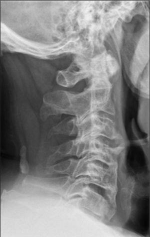Cervical spine X-ray: the height of the vertebral bodies are preserved. Calcification projected onto the soft tissues in the dorsal section in the occipito-vertebral ligament.