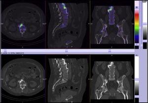 SPECT/CT: calcification of common anterior vertebral ligament and preservation of intervertebral disc spaces.