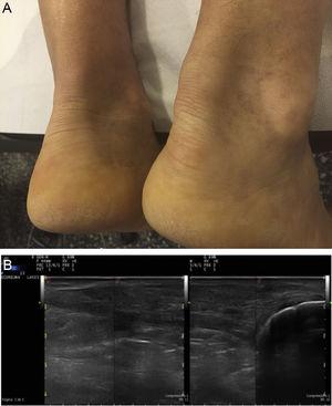A. Tendon xanthomas on Achilles tendons. B. Ultrasound of the same patient, of the Achilles tendon: a thickened tendon can be seen on a longitudinal slice, of heterogeneous echotexture.
