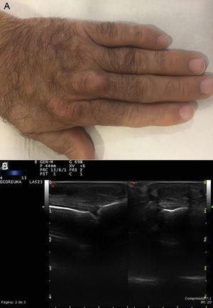 A. Tendon xanthomas on the extensor tendons of the fingers. B. Ultrasound of the same patient, extensor tendon of the third finger: a thickened tendon can be seen on a transversal and longitudinal slice, of heterogeneous echotexture.