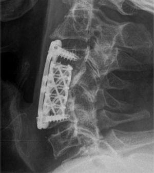 Radiograph of the cervical spine during postoperative follow-up.