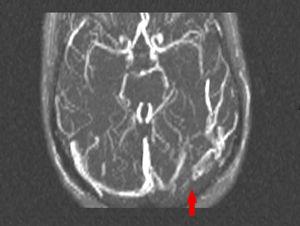 Venous transverse 2-dimensional time-of-flight magnetic resonance angiography; venous thrombosis in the left transverse sinus with slight prolongation into left sigmoid sinus.