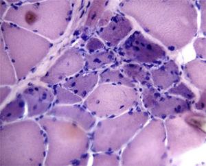 Muscle biopsy: inflammatory infiltration, with atrophy and perifascicular regeneration.