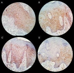 Expression of syndecan-1 in oral mucosa epithelium contiguous to osteonecrosis induced by BP. (A) Expression in cytoplasmatic membrane. (B and C) A loss of expression is observed in the superficial area of the epithelium. (D) Loss of expression of syndecan-1 in all areas of the epithelium.