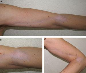 (A–C) Hypopigmented atrophic patch on the elbow, with linear extension along the upper arm.