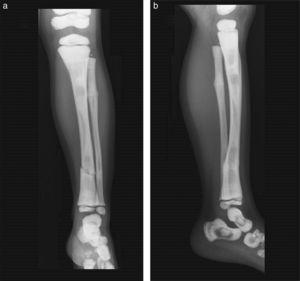 X-rays of the right leg in anteroposterior (a) and lateral (b) projection. Transversal fracture in distal shaft of the right tibia and fibula. Fracture callus in proximal end of fibula. General sclerosis of the visible bony structures with poor differentiation between cortical and medullary cavity.