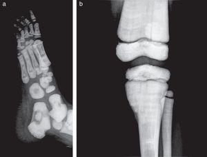 Oblique lateral projection of right foot (a) in which the appearance of “bone within bone” is identified and anteroposterior projection of the knee (b) in which there is an enlargement of the femur and tibia metaphyses with “mace” appearance.