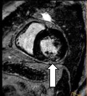 CMR shows a reduction of the patchy intramyocardial involvement after immunosuppressant treatment (the arrow indicates the area of myocardial involvement which has shrunk compared with the previous CMR).