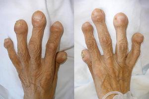 Large bilateral acropachies.