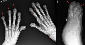(A) Anteroposterior X-ray of both hands. Thickening of the soft tissues at the level of the distal fingers. Marked destructive changes with acro-osteolysis in all of the distal fingers (arrowed), with formation of flat surfaces in both the fifth fingers, bone proliferation at the level of the left radius and more discretely at the base of several distal fingers (arrow points). (B) Oblique X-ray of the right foot. Re-absorption of all of the distal toes with formation of flat surfaces (arrowed).