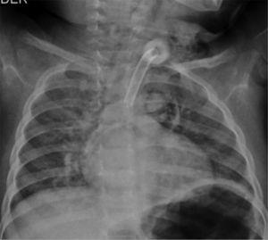Plain chest X-ray with evidence of diffuse micronodular bilateral perihilar infiltrate.