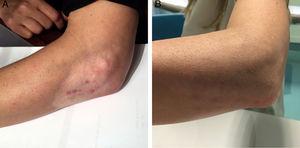 (A) Skin hypopigmentation and subcutaneous fat atrophy in the right elbow of the patient after corticosteroid injections; (B) elbow surface 24 months after fat graft.