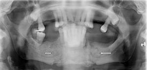 Image showing the bilateral fracture of the jaw in a mandibular osteonecrosis induced by biphosphonate (the 2 arrows mark the fracture lines).