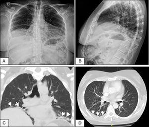(A and B) Front and side-view chest X-rays showing the elevation of both hemidiaphragms and bibasilar laminar atelectasis. (C) Coronal CT without contrast material showing diaphragmatic elevation and subsegmental atelectasis (arrows) in both lung bases. (D) Axial CT of the chest with contrast material showing slight pleural effusion in the right lung base (arrows).