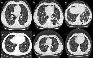 (a–c) Bilateral patchy pulmonary infiltrates are seen mostly in the lower lung lobes; (d–f) complete regression of the lung infiltrates after one month of treatment.