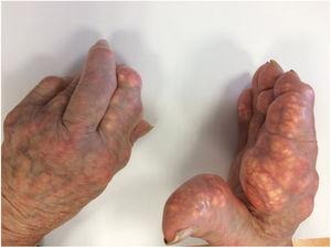 Tophaceous deposits in the hands.