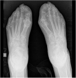 X-ray image of feet: erosion in the first metatarsophalangeal joints.