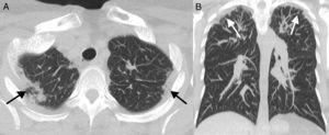 (A) Transversal pulmonary CTA slice. (B) Coronal CTA pulmonary slice. In both slices the presence of subpleural consolidations may be seen, together with predominantly apical bilateral pleural thickening.
