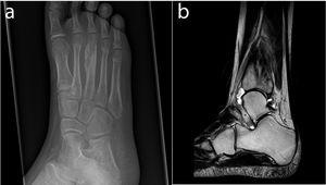 (a) X-ray of the right foot showing a focus of lucency in the distal metaphysis of the third metatarsal, extending to the growth plate with multi-lamellated periosteal reaction (b). MRI of the right ankle showing diffuse bone marrow oedema, fibular periosteal response, the localised medial fibular cortical defect and the tibiotalar joint effusion.