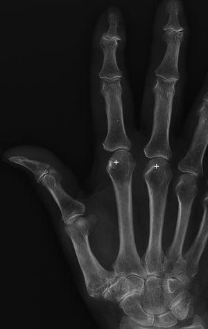 AP X-ray of the hand of a patient with osteoarthritis, without haemochromatosis. As an example for comparison, neither involvement of the metacarpophalangeal joints nor the formation of hook-like osteophytes (+) can be observed.