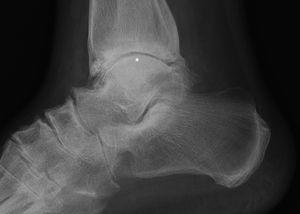 Lateral X-ray of left ankle. Severe joint impingement and marginal osteophytes (*).