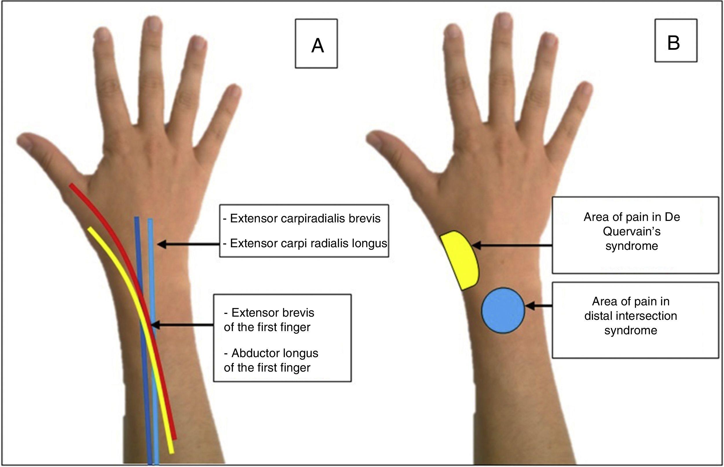 extensor tendonitis wrist