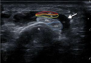 Transverse ultrasound image of the distal region of the right forearm. Showing tenosynovitis (arrow) of the tendons of the I and II extensor compartment as they cross. AL: abductor longus of the first finger; EB: extensor brevis of the first finger; ECRB: extensor carpi radialis brevis; ECRL: extensor carpi radialis longus; R: radius.