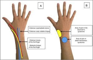 (A) Anatomical path of the tendons involved in distal intersection syndrome. (B) Site of pain in distal intersection syndrome and in De Quervain's tendonitis.