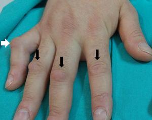 Painless nodules of a soft consistency on the back of the proximal interphalangeal joints of the hand, termed Garrod pads (black arrows). In addition to the Garrod pads a proximal interphalangeal joint flexion contracture of the fifth finger can be seen, known as camptodactyly (white arrow). When this association presents, associated genetic syndromes should be ruled out. Likewise, we should remember that camptodactyly has been described associated with arthritis and constrictive pericarditis.