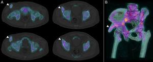 (A) Axial slices of the SPECT/CT image fusion with 99mTc-HDP. (B) 3D reconstruction of the SPECT/TC imaging.