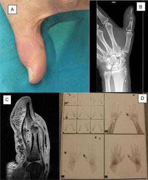 (A) Swelling and erythema of the interphalangeal joint of the thumb. (B) Plain X-ray. (C) Sagittal sequence of the first finger enhanced in T2 in the RMN. (D) Gallium 67 scan.