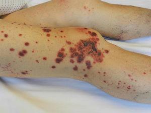 Clinical image of the patient who presented with palpable purpura in lower limbs with formation of haemorrhagic blisters.