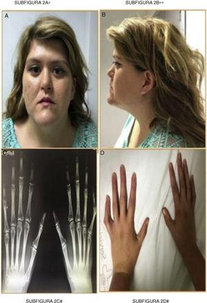 Frontal phenotype (A), lateral (B), hand radiology (C) and arachnodactyly (D). Depressed nasal bridge, face hypoplasia, macrognathia, proptosis, low implantation of the auricular pavilion. Elongated hands and hyperlaxity. Increased length of metacarpals and phalanges.