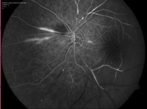 Fluorescein angiography Ischaemia in temporal area, arterial occlusion, and active vasculitis in the nasal pole.