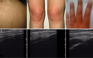 (A) Dermographism observed in case 1. (B) Appearance of the knees 1h after physical activity in case 1. (C) Appearance of the hands in case 2 after isometric dumbbell exercises. (D) From left to right: basal situation of the pre-patellar recess of the patient of case 3, 1h after exercise and 3h later.