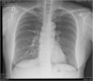 Postero-anterior chest X-ray.