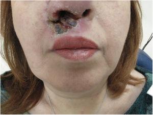 Ulcerous, mucocutaneous lesion in nasal vestibule and upper lip.