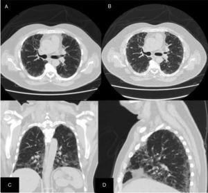 (A) and (B) Axial routine chest CT lung window, (C) and (D) coronal and sagittal reconstructed images (lung window) showing bilateral pulmonary sub pleural interstitial infiltrates with tendency to honey combing and traction bronchiectatic changes; (C) and (D) are showing the same changes.