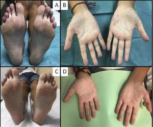 Digital ischaemia at onset and its evolution after treatment. A and B) Digital ischaemia and vasculitic lesions on palms of hands at onset. C and D) Improvement after one month of treatment.