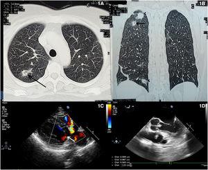 (A and B) Contrast enhanced computed tomography of chest showed multiple irregular nodules in both lung with central cavitation and surrounding consolidation. (C and D) Transthoracic echocardiography showing ventricular septal defect with two vegetations on non-coronary cusp and right side of interventricular septum.