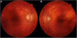 Color Retinography. Absence of significant fundoscopic alterations. Bilateral retinal pigment epithelium atrophy at the peripapillary level, slightly extending along the path of the temporal arches (A and B). Optic disc slightly oblique in the LE (B).