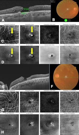 Multimodal BE image. A. Macular OCT of RE showing full-thickness macular hole with measurements of the hole (inner diameter 624 μm, and basal diameter 920 μm) without vitreous traction at the edges of the hole. B. Color fundus photograph shows artifact in foveal area, migration of temporal RPE to fovea. C. OCT angiography shows circular hyperreflective lesion corresponding to the macular hole (yellow arrow), nasal to telangiectatic vessels. D. En-face image shows the same hyperreflective lesion nasal to the macular telangiectasias (yellow arrow). E. OCT of the LE shows alteration of the foveal architecture, hyperreflective lesions in intermediate layers, loss of the outer segments of the temporal photoreceptors to the fovea, foveal hyperreflective lesions corresponding to cavitations and thickened choroid. F. Color fundus photograph shows artifact in foveal area, migration of temporal RPE to fovea. G. OCT. Angiography shows temporal telangiectasias to the fovea in the superficial and deep plexuses. H. En-face image shows temporal hyperreflective lesions to the fovea.