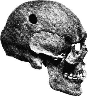Prehistoric skull with a burr hole.