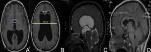 Presurgical imaging studies (A and B): T1-weighted brain MRI without contrast that revealed triventricular hydrocephalus. Evans index was 0.43 (B) and third ventricle diameter was >1.4cm (A). Presurgical study (C): T2-weighted MRI showing increased convexity of the corpus callosum, flattening of the midbrain, and stenosis of the aqueduct of Sylvius. Postsurgical studies (D): T1-weighted MRI without contrast that revealed decreased ventricular size, upward displacement of midbrain, and the endoscope path for the third ventriculostomy.
