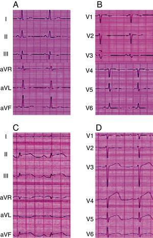 (A and B) Presurgical electrocardiogram showed no changes. (C and D) The electrocardiogram performed after the endoscopic third ventriculostomy revealed changes indicative of stunned myocardium (ST segment elevation and inverted T wave).