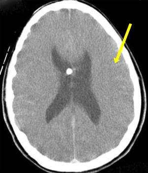 Cranial computed tomography after the endoscopic third ventriculostomy that revealed subarachnoid haemorrhage on the cortical convexity sulci (arrow).